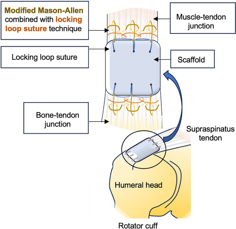 Establishing a rabbit model with massive supraspinatus tendon defect for investigating scaffold-assisted tendon repair.