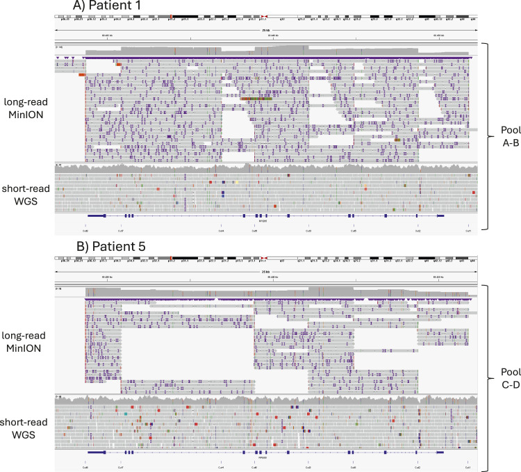 Cas9-targeted-based long-read sequencing for genetic screening of <i>RPE65</i> locus.