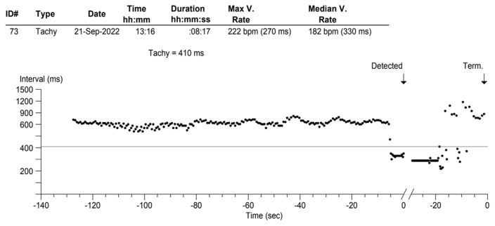 Mitral Valve Prolapse with Syncope: Don't Judge the Book by its Cover!