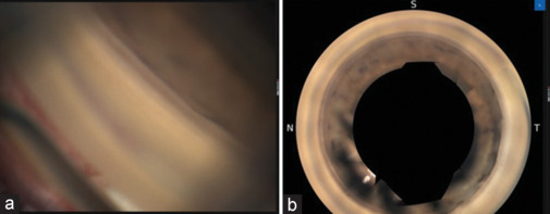Detection of iridocorneal angle changes after uncomplicated phacoemulsification using automated gonioscopy imaging.