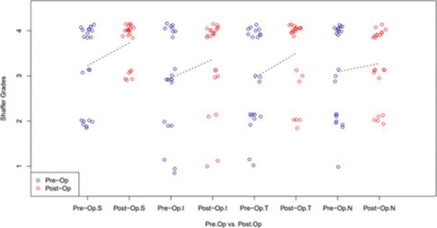 Detection of iridocorneal angle changes after uncomplicated phacoemulsification using automated gonioscopy imaging.