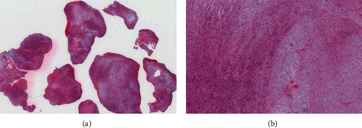Sellar Schwannoma Masquerading as Giant Pituitary Adenoma: A Diagnostic Challenge.