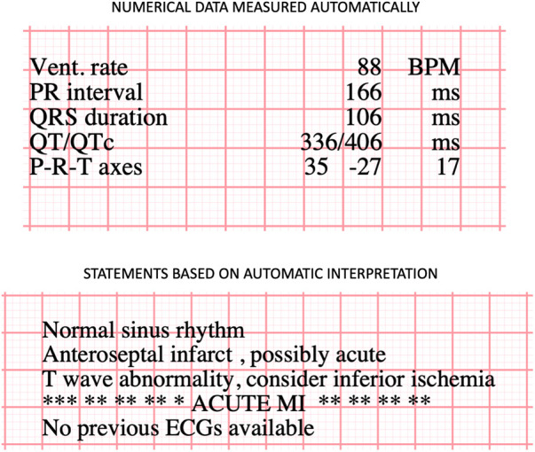 Predicting long-term risk of sudden cardiac death with automatic computer-interpretations of electrocardiogram.