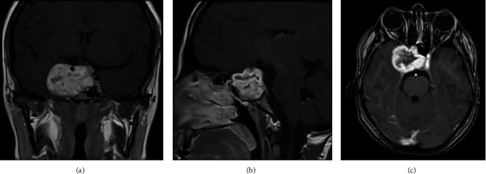 Sellar Schwannoma Masquerading as Giant Pituitary Adenoma: A Diagnostic Challenge.