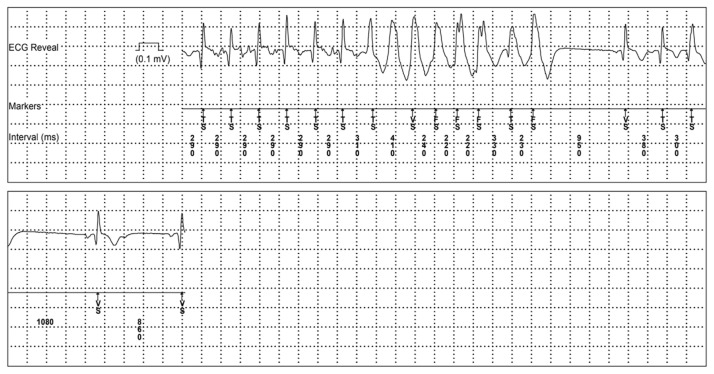 Mitral Valve Prolapse with Syncope: Don't Judge the Book by its Cover!