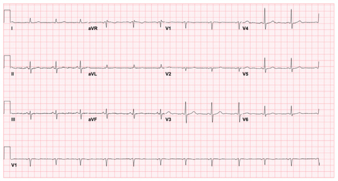 Mitral Valve Prolapse with Syncope: Don't Judge the Book by its Cover!