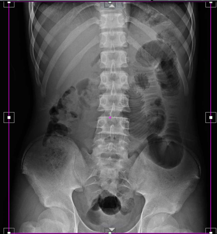 Impact of Electronic Collimation on Reducing Unnecessary Patient Dose in Digital Radiography.