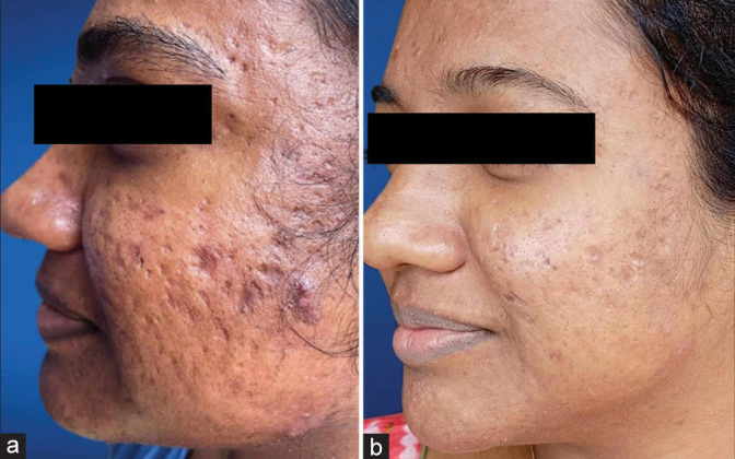 Efficacy and safety of microneedling radiofrequency in acne scars.