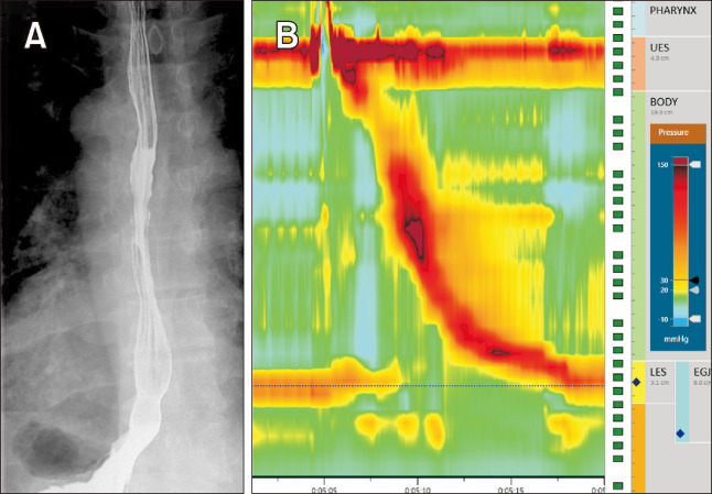 Opioid-induced Esophageal Dysfunction Masquerading as Type I Achalasia.