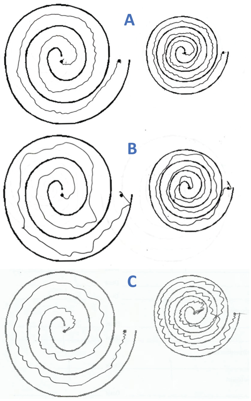 Tremor Following Guillain Barré Syndrome.