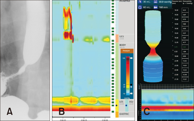 Opioid-induced Esophageal Dysfunction Masquerading as Type I Achalasia.