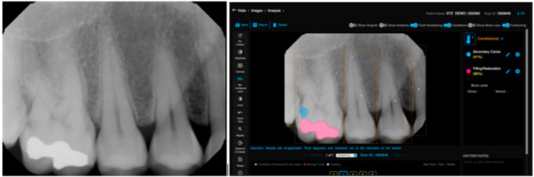 Clinical Validation of Deep Learning for Segmentation of Multiple Dental Features in Periapical Radiographs.