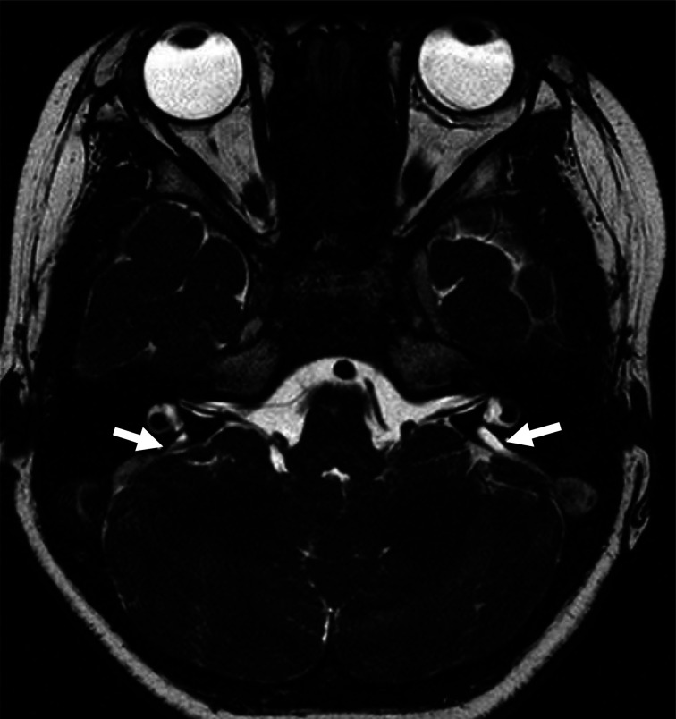 Hearing loss with two pathogenic <i>SLC26A4</i> variants and positive thyroid autoantibody: A case report.
