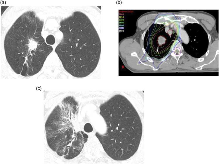 Computed tomography patterns and clinical outcomes of radiation pneumonitis in non-small-cell lung cancer patients.