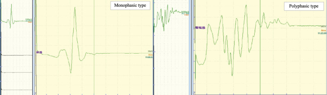 Correlation between Delayed Relief after Microvascular Decompression and Morphology of the Lateral Spread Response in Patients with Hemifacial Spasm-Further Examination with Compound Motor Action Potentials.