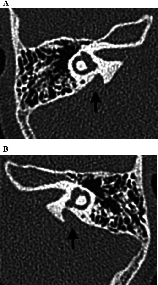 Hearing loss with two pathogenic <i>SLC26A4</i> variants and positive thyroid autoantibody: A case report.