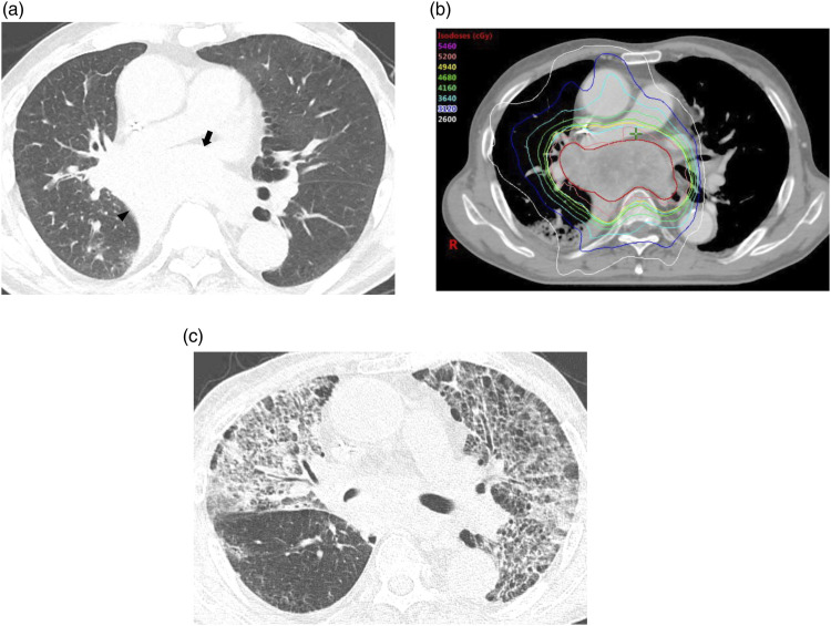 Computed tomography patterns and clinical outcomes of radiation pneumonitis in non-small-cell lung cancer patients.