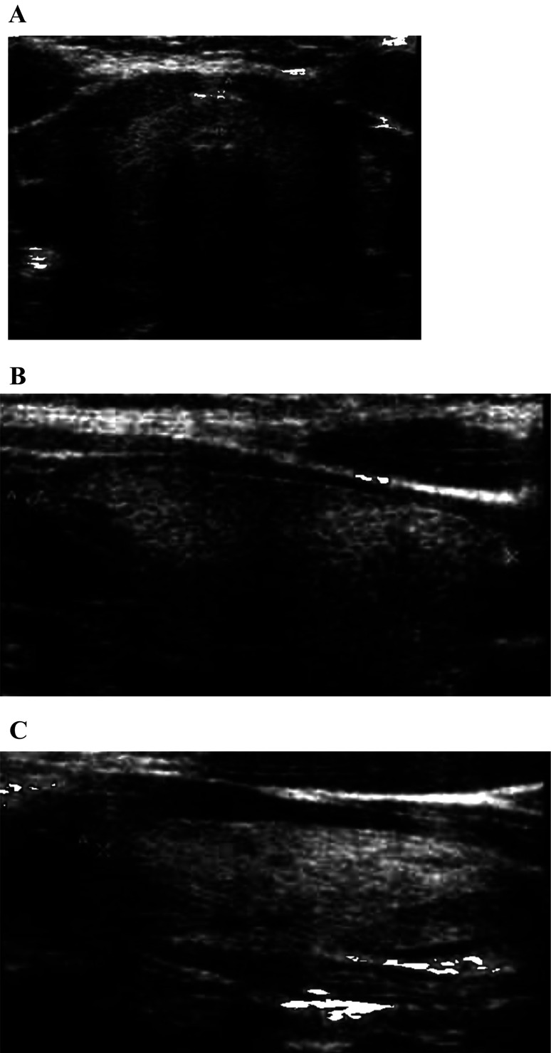 Hearing loss with two pathogenic <i>SLC26A4</i> variants and positive thyroid autoantibody: A case report.
