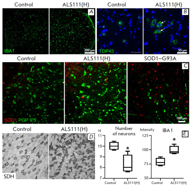 Intraventricular Administration of Exosomes from Patients with Amyotrophic Lateral Sclerosis Provokes Motor Neuron Disease in Mice.