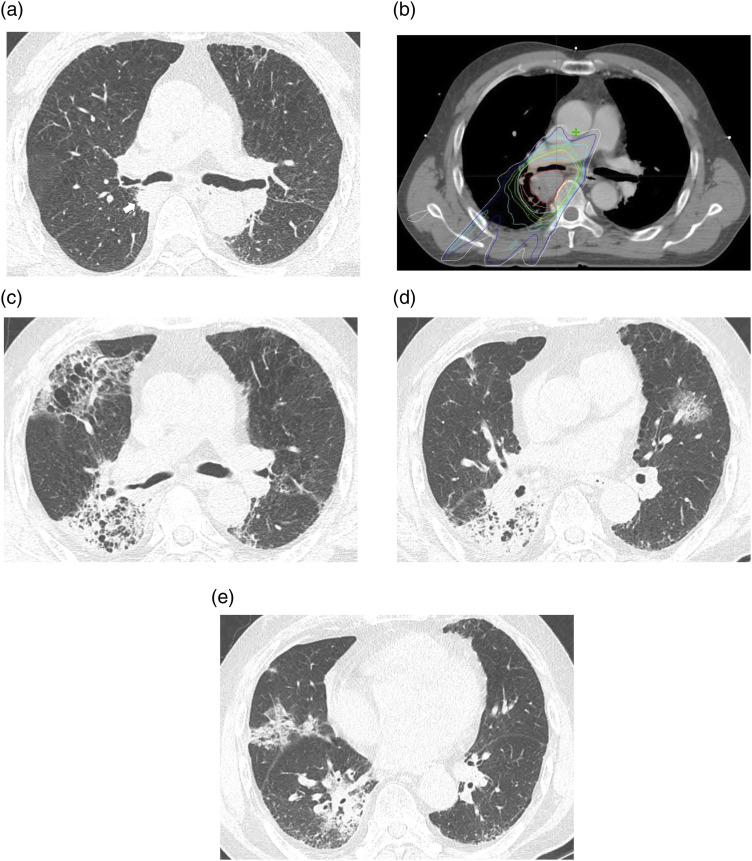 Computed tomography patterns and clinical outcomes of radiation pneumonitis in non-small-cell lung cancer patients.