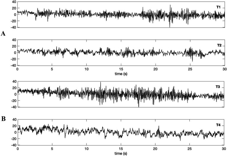 Revisiting the earliest hyperscanning study: power and functional connectivity in the alpha band may link brains far apart.