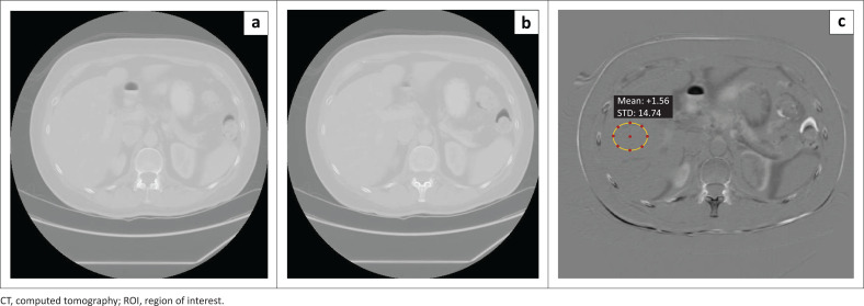 Clinical diagnostic reference levels and image quality metrics for CT in oncology patients.