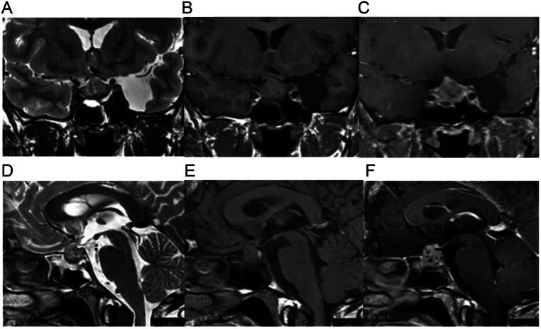 Complete remission after glucocorticoid therapy in a patient with primary hypophysitis.
