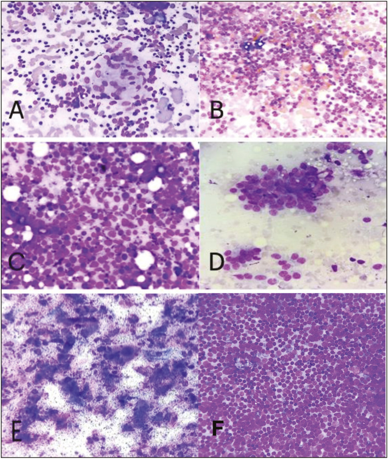 Application of the Sydney System for Classification and Reporting Lymph Node Cytopathology to Assess the Risk of Malignancy and its Diagnostic Accuracy.