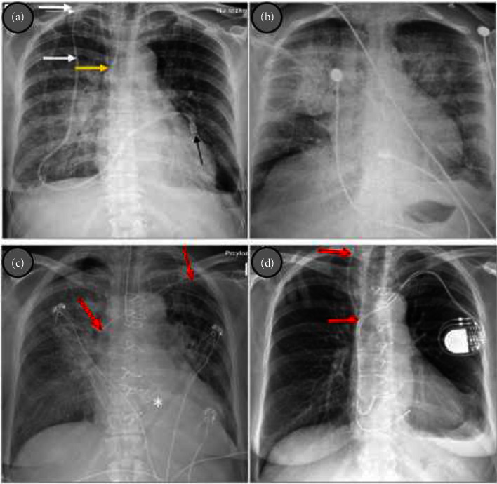 Broviac Catheter-Related Aortic Valve Infective Endocarditis Complicated With Massive Aortic Regurgitation Requiring Emergency Surgery: A Case Report.