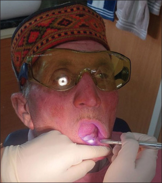 Evaluation of effect of low-level laser therapy on alleviation of pain in patients with implant-supported mandibular overdenture: A pilot study.