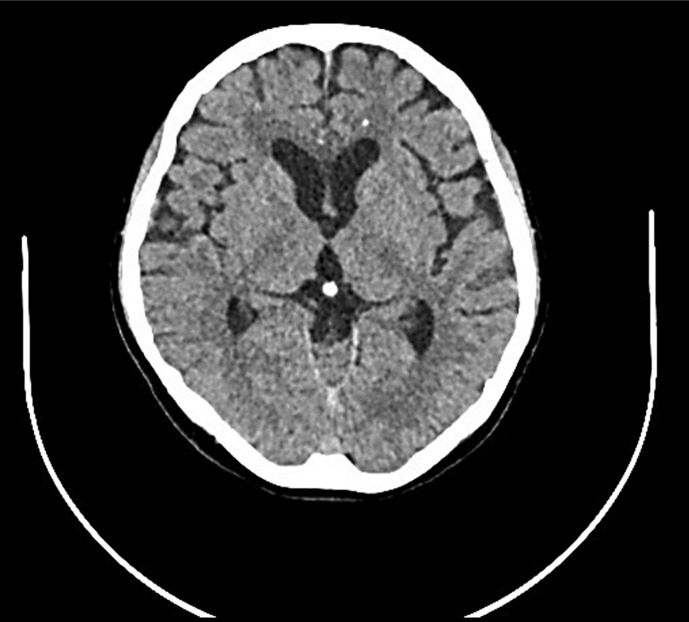 Suspected Postpartum Depression Revealed to be CSF1R-Related Leukoencephalopathy: A Case Report.