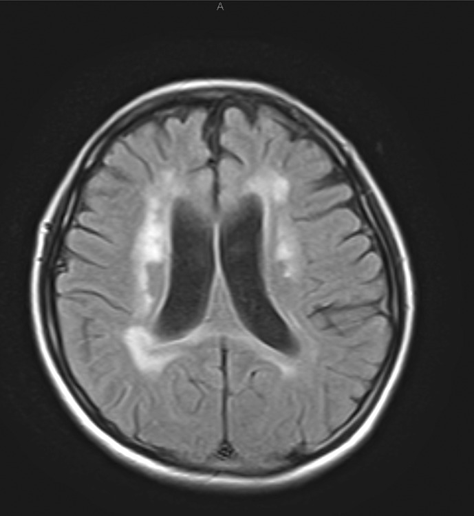 Suspected Postpartum Depression Revealed to be CSF1R-Related Leukoencephalopathy: A Case Report.