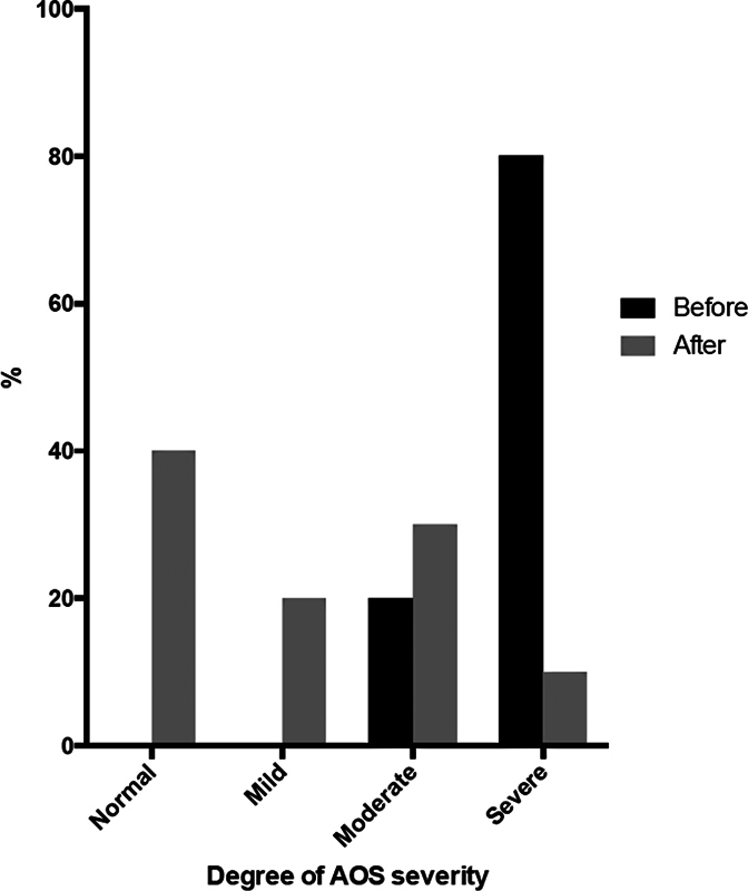 Efficacy of Expansion Pharyngoplasty without Drug-induced Sleep Endoscopy Screening in Obstructive Sleep Apnea.