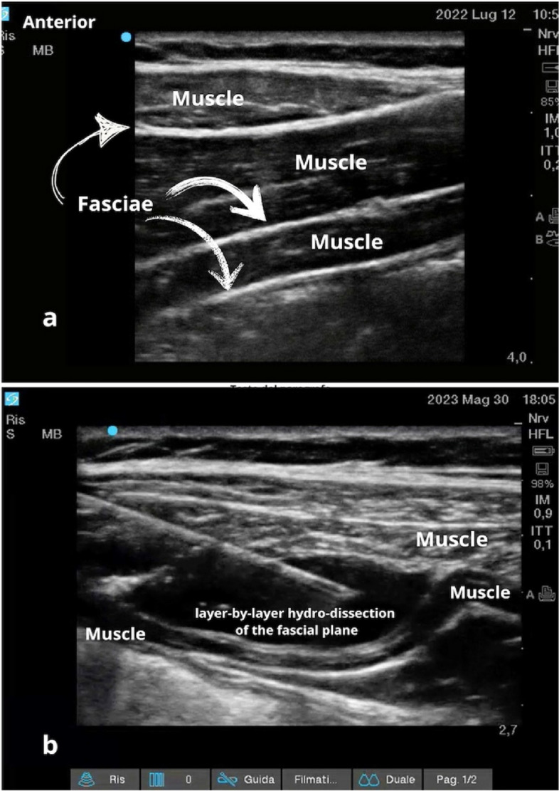 Ultrasound-guided fascial plane blocks in chronic pain: a narrative review.