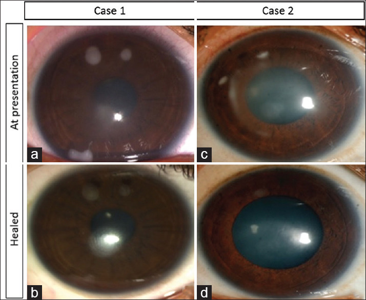 Outcomes of pediatric sterile keratitis posthypotonic collagen cross-linking.