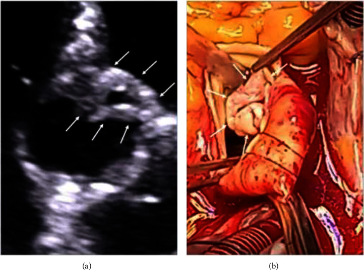 Broviac Catheter-Related Aortic Valve Infective Endocarditis Complicated With Massive Aortic Regurgitation Requiring Emergency Surgery: A Case Report.