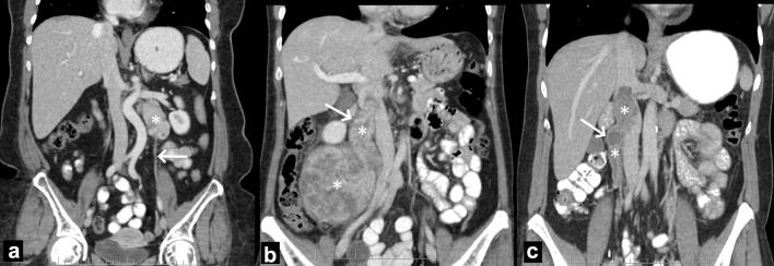 On the Origin of Abdominal Venous Leiomyosarcomas: The Role of the Sex-Hormone Drainage Pathways.