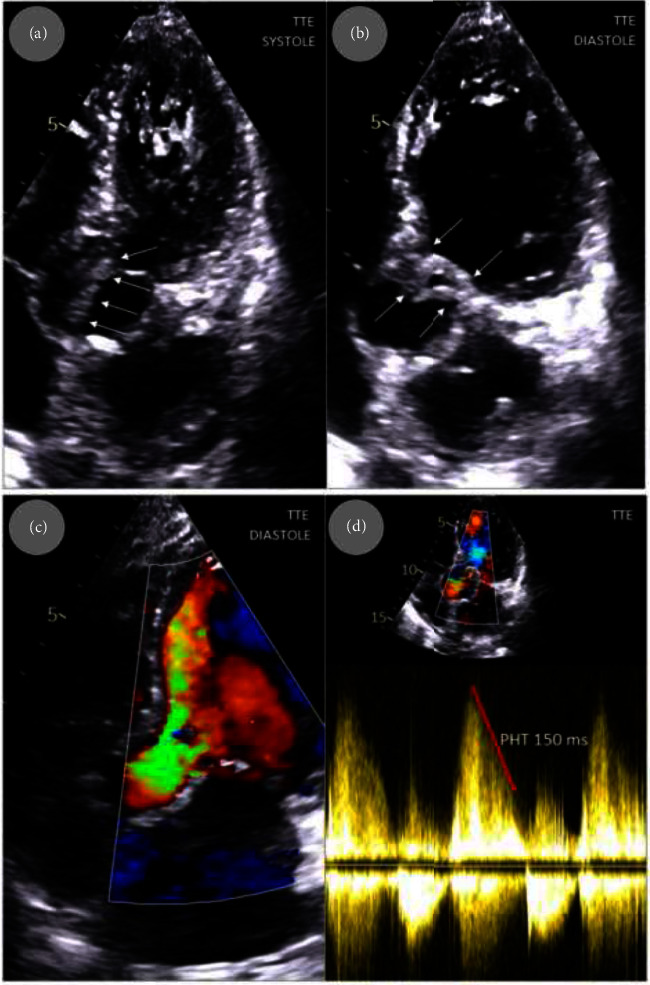 Broviac Catheter-Related Aortic Valve Infective Endocarditis Complicated With Massive Aortic Regurgitation Requiring Emergency Surgery: A Case Report.