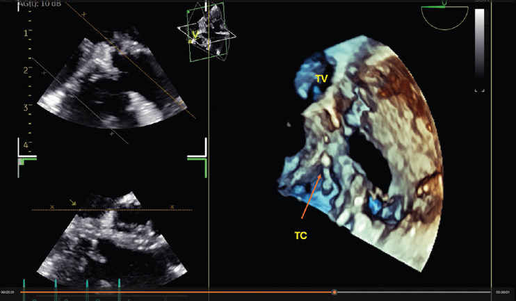 Pediatric Three-dimensional Transesophageal Echocardiography: A Game Changer in Congenital Heart Disease.