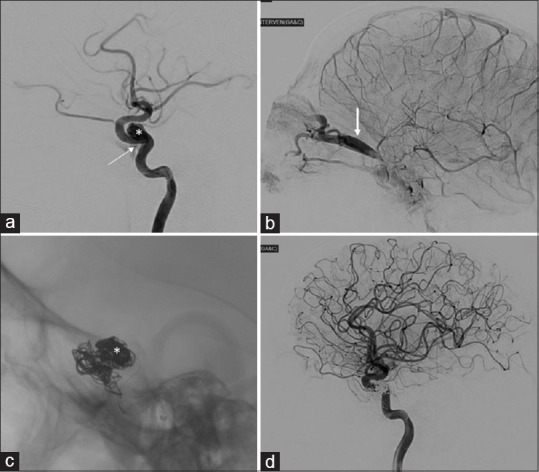 Evisceration and ocular prosthetic implantation following endovascular coiling for the management of endophthalmitis in a long-standing post-traumatic unilateral carotid-cavernous fistula: A case report and review of the literature.