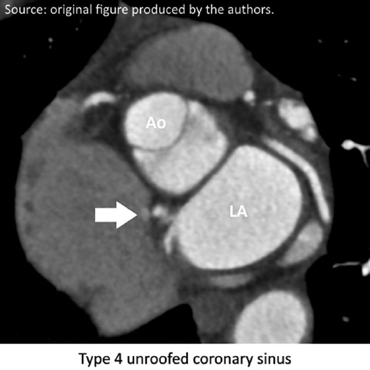 Cardiac Computed Tomography Detected the Hidden Culprit of a Cryptogenic Stroke: A "Cold" Case.