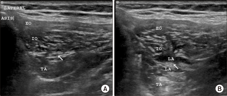 Effect of ultrasound-guided ilioinguinal-iliohypogastric nerve block on chronic pain in patients undergoing open inguinal hernia surgery under spinal anesthesia: a randomized double-blind study.