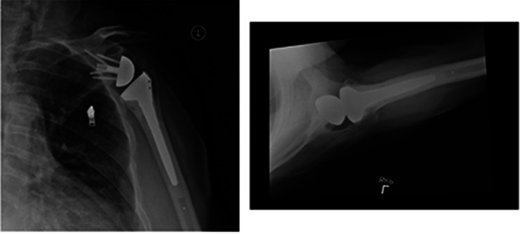 Use of a Low Profile Ultra-High Molecular Weight Polyethylene Diaphyseal Humeral Cement Restrictor in Shoulder Arthroplasty.