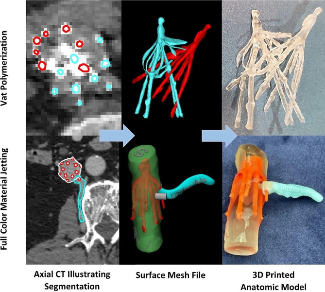 Planning for complex inferior vena cava filter retrievals: the implementation and effectiveness of 3D printed models.