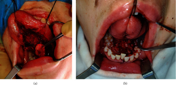 The Sublingual Gland Flap for Oral Reconstruction: Insights From a Single Institutional Experience.
