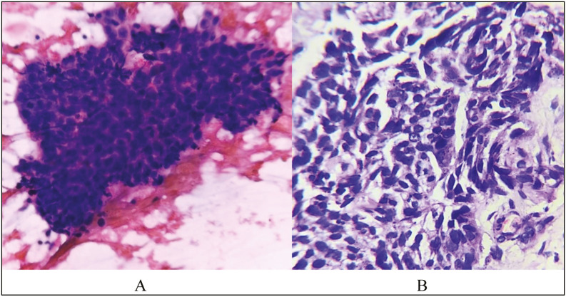 Application of the Sydney System for Classification and Reporting Lymph Node Cytopathology to Assess the Risk of Malignancy and its Diagnostic Accuracy.