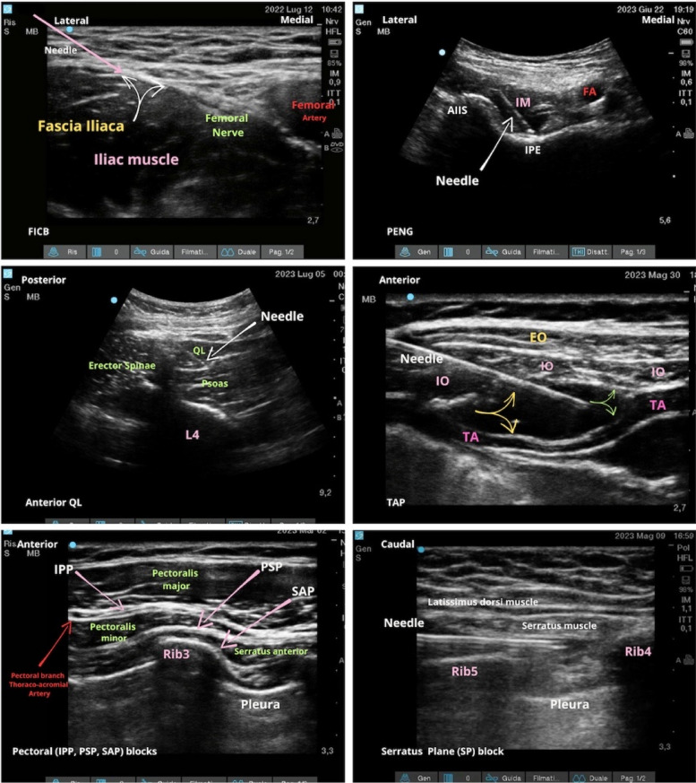 Ultrasound-guided fascial plane blocks in chronic pain: a narrative review.