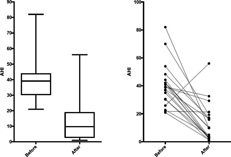 Efficacy of Expansion Pharyngoplasty without Drug-induced Sleep Endoscopy Screening in Obstructive Sleep Apnea.