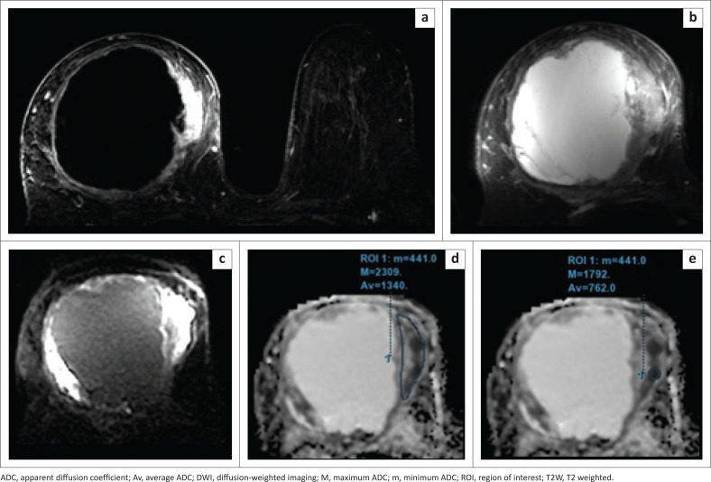 Utility of diffusion-weighted imaging in differentiating benign and malignant breast lesions.