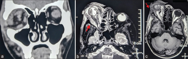Evisceration and ocular prosthetic implantation following endovascular coiling for the management of endophthalmitis in a long-standing post-traumatic unilateral carotid-cavernous fistula: A case report and review of the literature.
